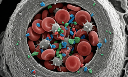 Araştırmacılar mikroplastiklerin atardamarları tıkadığına dair kanıt buldu