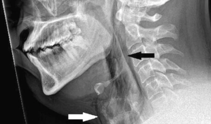 Nefes borusu yırtılan hastadan sonra doktorlardan 'hapşırığınızı tutmayın' uyarısı