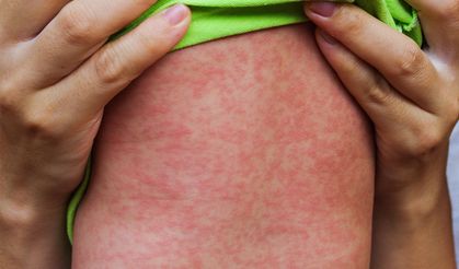 DSÖ uyardı: Kızamık vakaları dünya genelinde yüzde 79 arttı