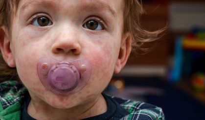 Avusturya'daki kızamık dalgası sonrası Tabipler Birliği'nden acil aşı çağrısı